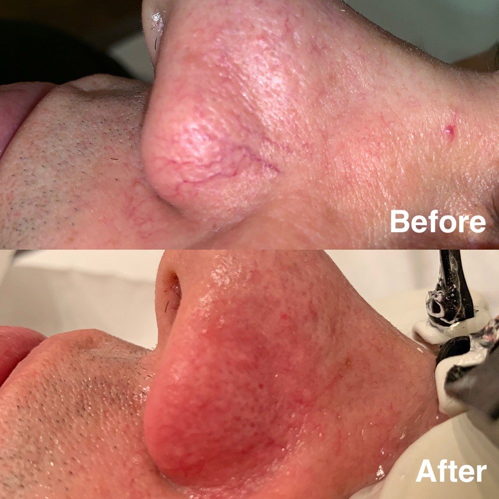 Broken veins before and after treatment