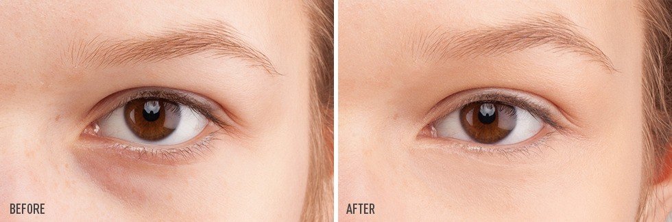 Eye treatment before and after